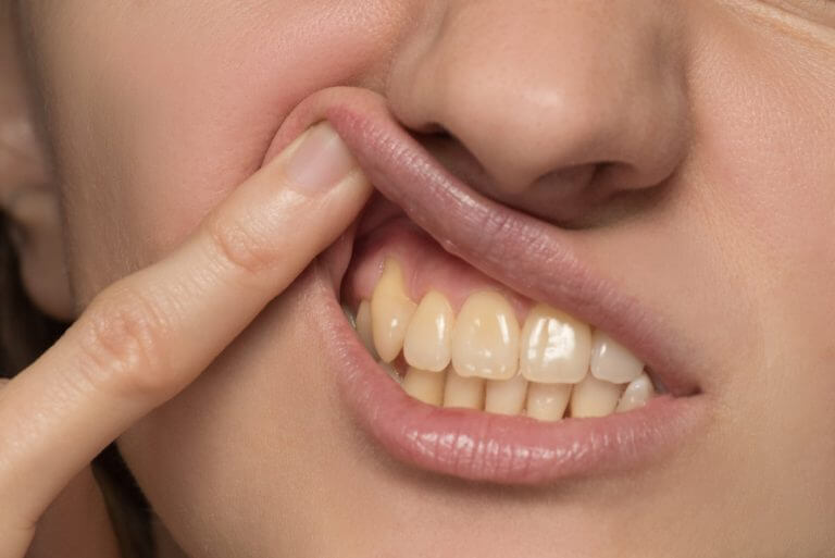 Zahnverfärbungen Warum sich Zähne gelblich verfärben