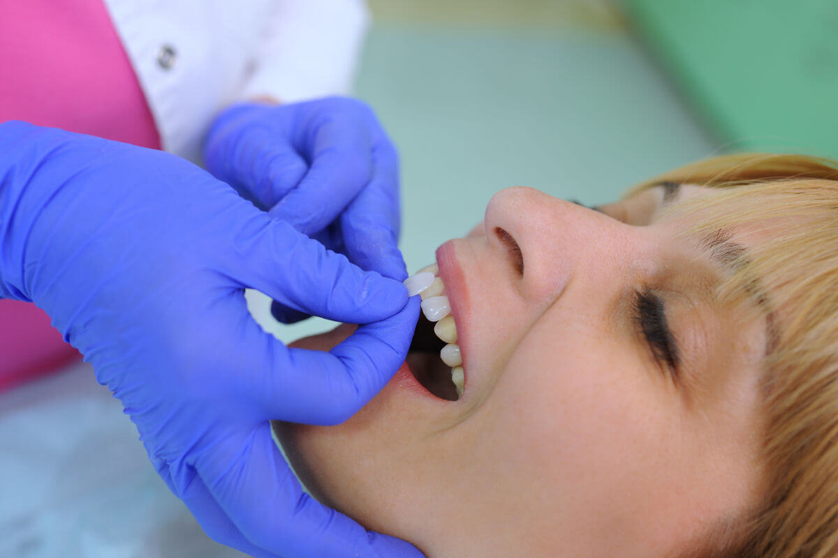 La cementazione delle faccette dentali