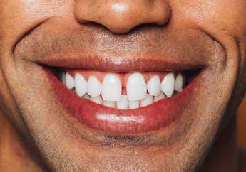 Die Besten Zahnbleaching Sets Mann lacht Eingangsfoto 30